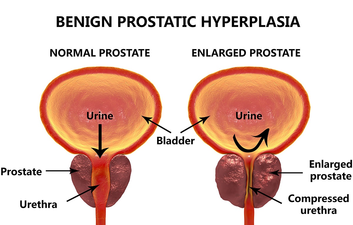 What Is A Normal Prostate News Digest Healthy Options